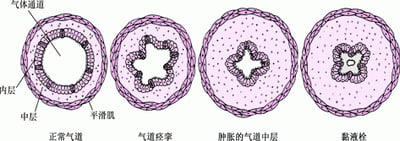 气道如何收窄