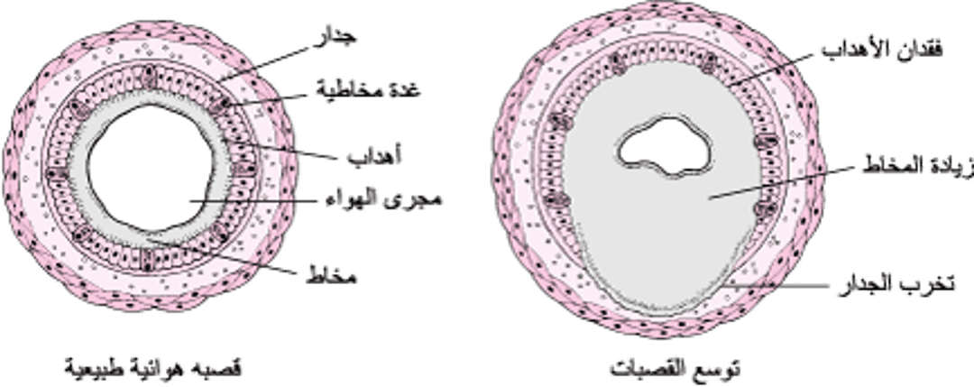 فهمُ توسُّع القصبات