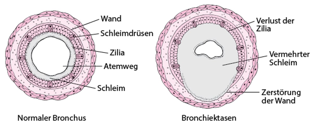 Was bei Bronchiektasen geschieht