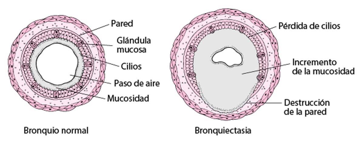 Qué es la bronquiectasia