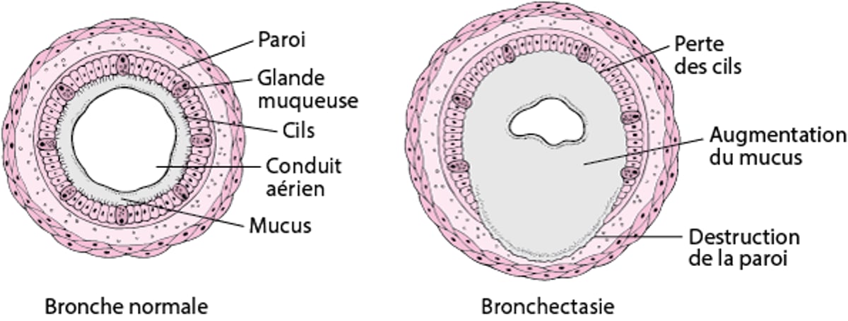 Qu’est-ce que la bronchectasie (dilatation des bronches) ?
