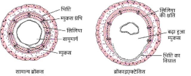 ब्रोंकाइएक्टेसिस को समझना
