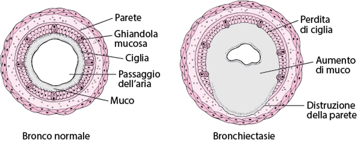 Cosa sono le bronchiectasie