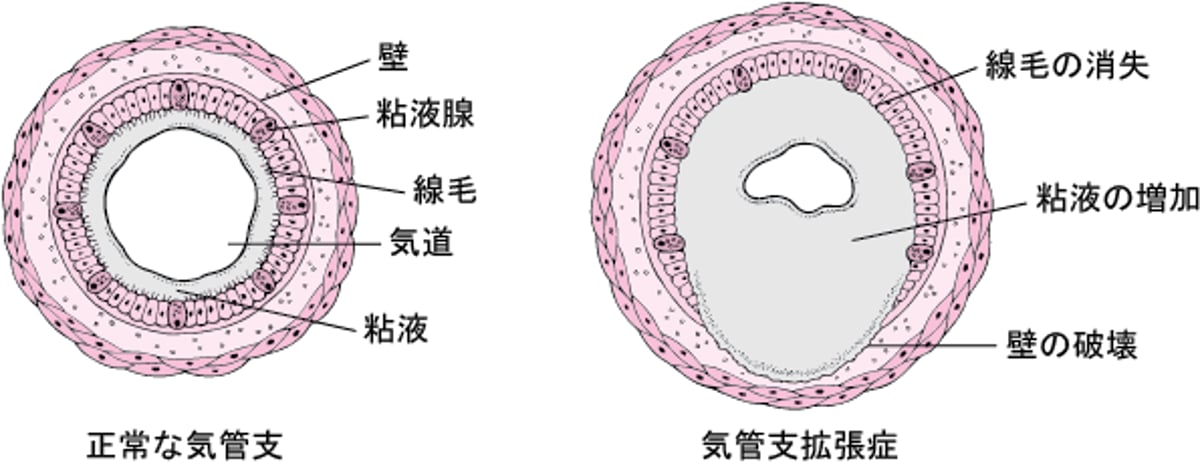 気管支拡張症について理解する