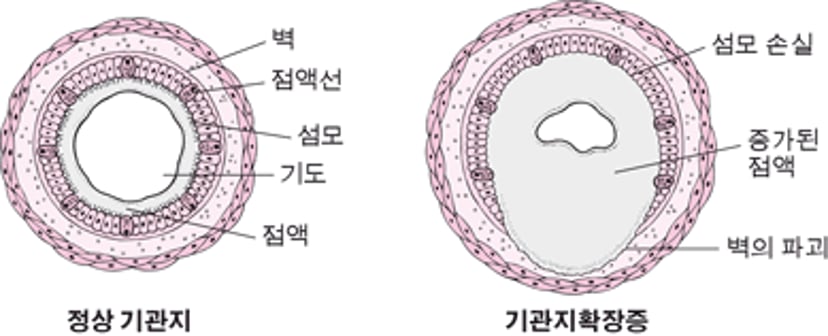 기관지확장증 이해