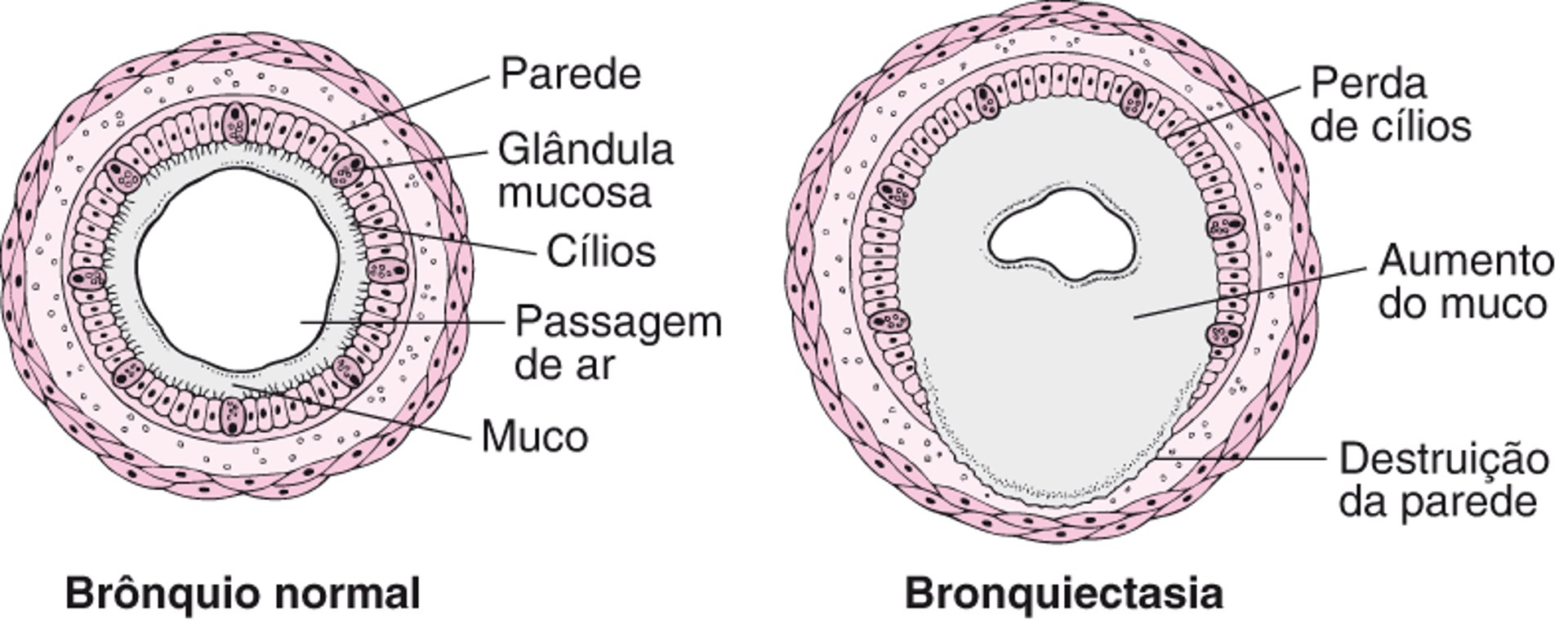Compreendendo a bronquiectasia