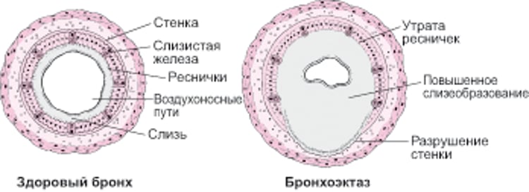 Что такое бронхоэктатическая болезнь