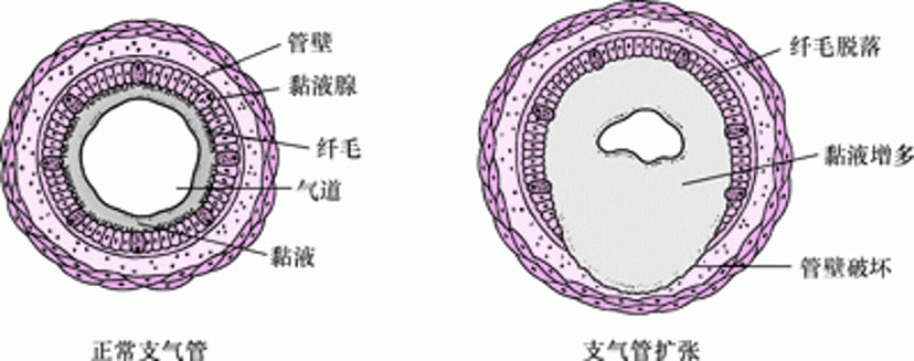 支气管扩张示意图