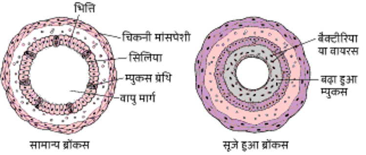 ब्रोंकोस्कोपी