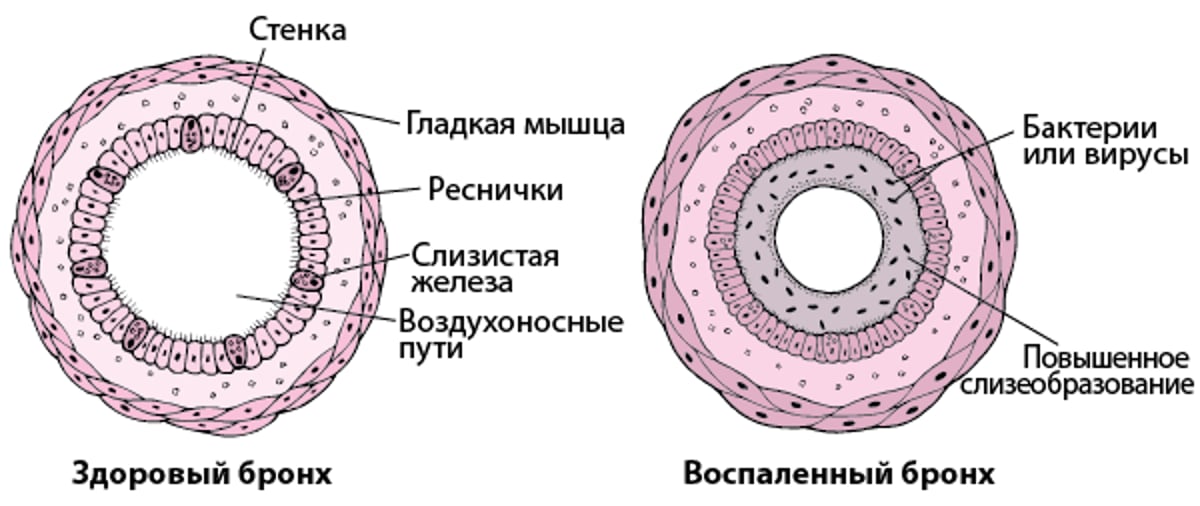 Бронхоскопия