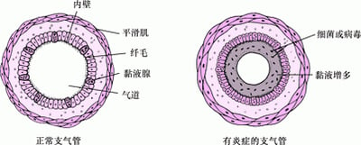 支气管镜