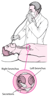 Understanding Flexible Bronchoscopy