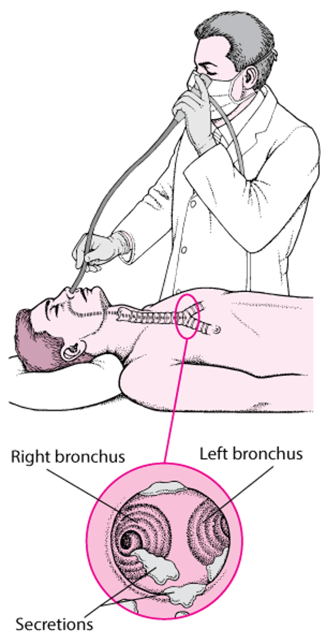 Understanding Flexible Bronchoscopy