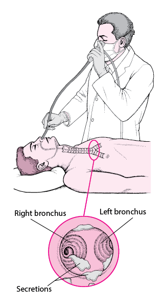 Bronchoscopy - Lung and Airway Disorders - Merck Manual Consumer Version