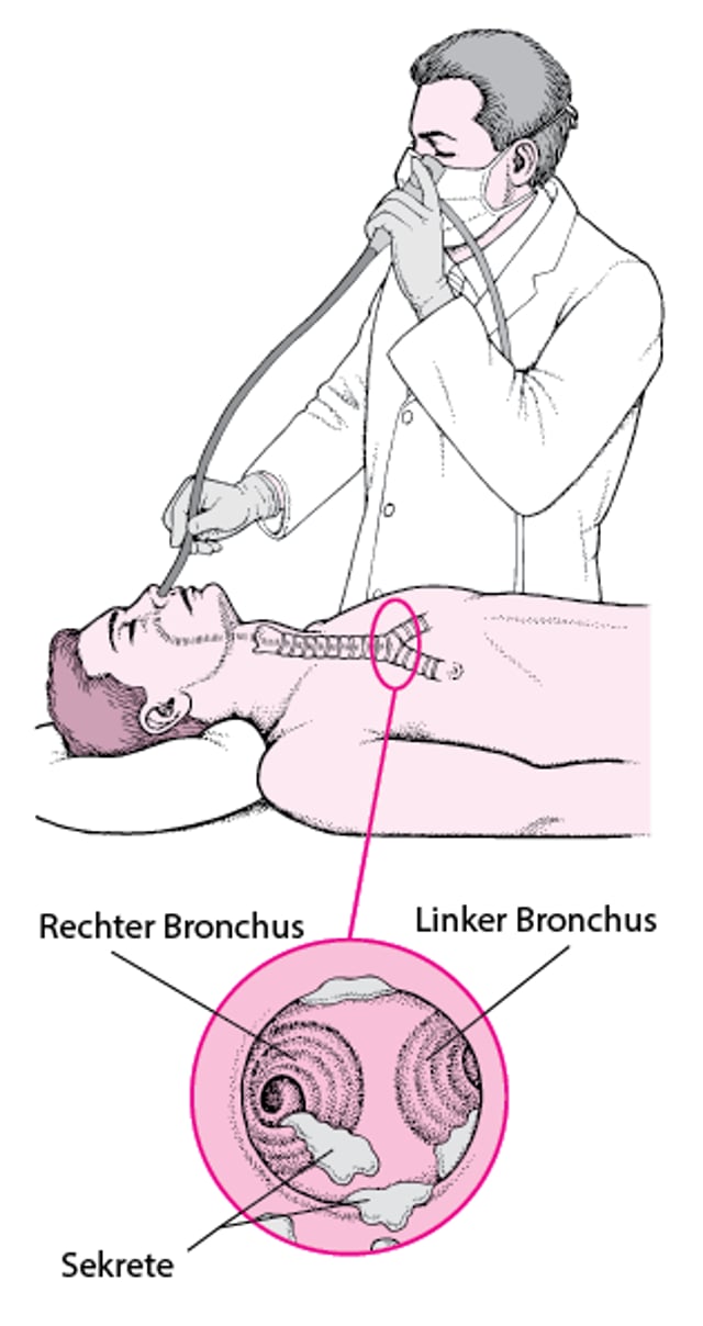 So funktioniert die Bronchoskopie mit einem biegsamen Schlauch