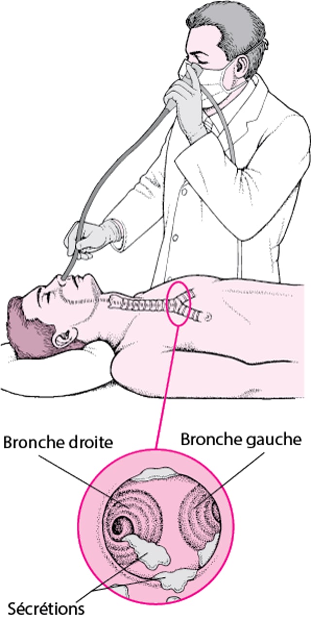 Comprendre la bronchoscopie souple