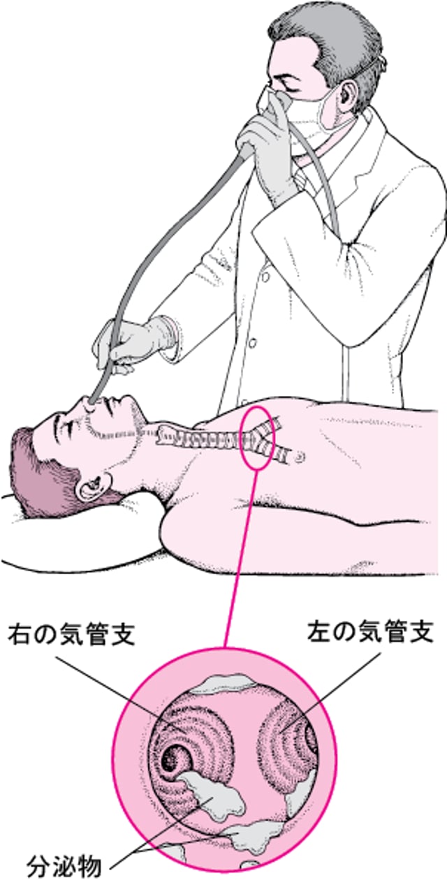 軟性気管支鏡について理解する