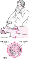 신축성 있는 기관지경술 이해하기