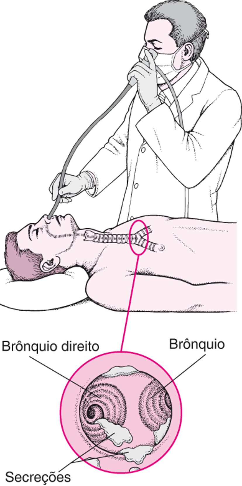 Entendendo a broncoscopia flexível