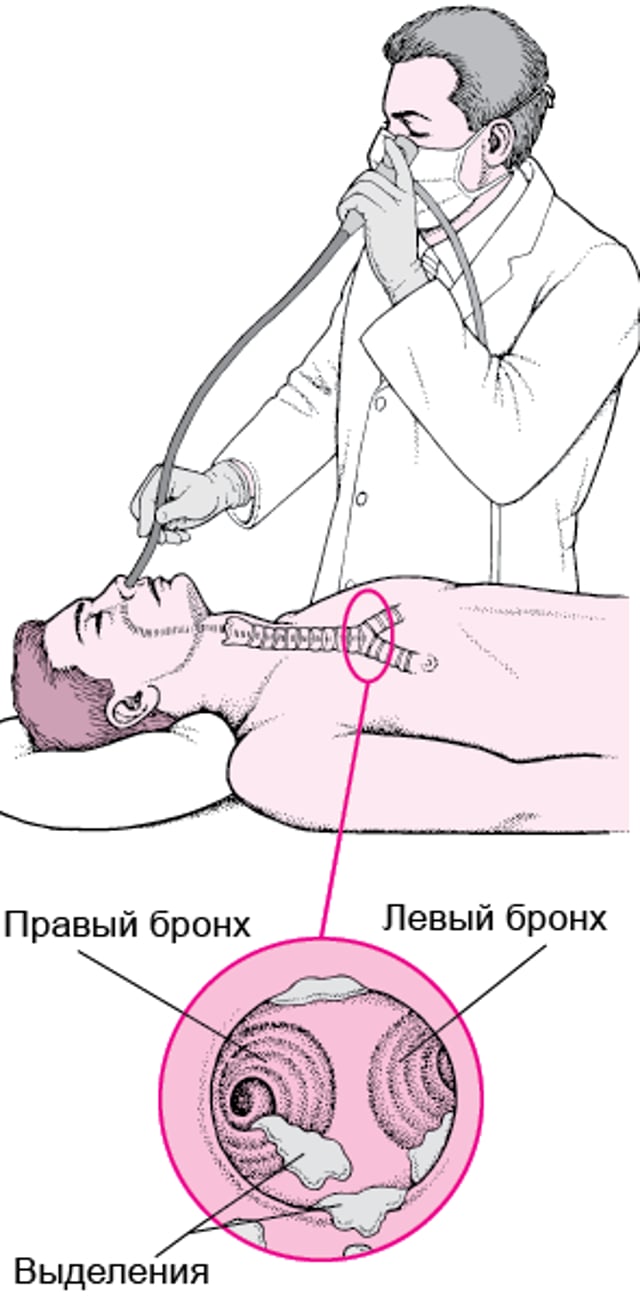 Представление о гибкой бронхоскопии