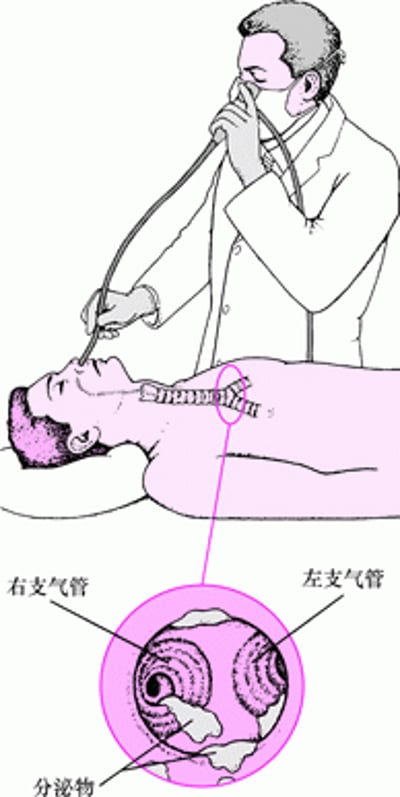 了解柔性支气管镜检查