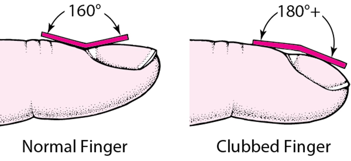 Recognizing Finger Clubbing