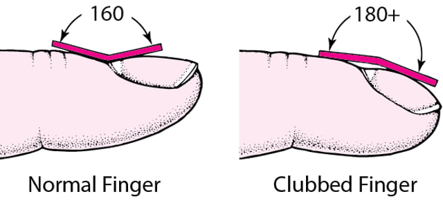 Image:Recognizing Finger Clubbing-Merck Manual Consumer Version