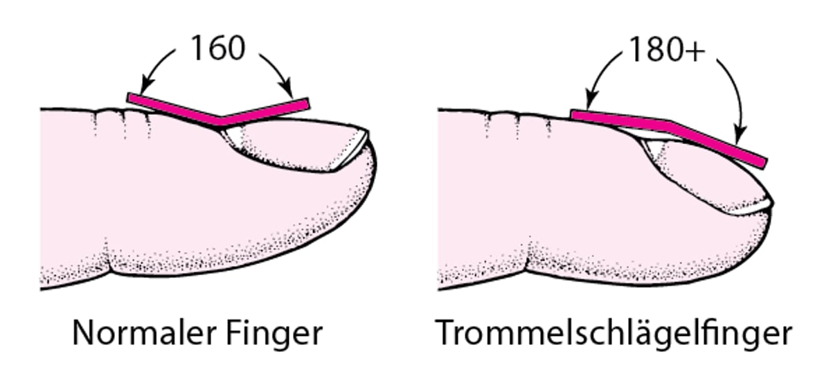Erkennen von Trommelschlägelfingern
