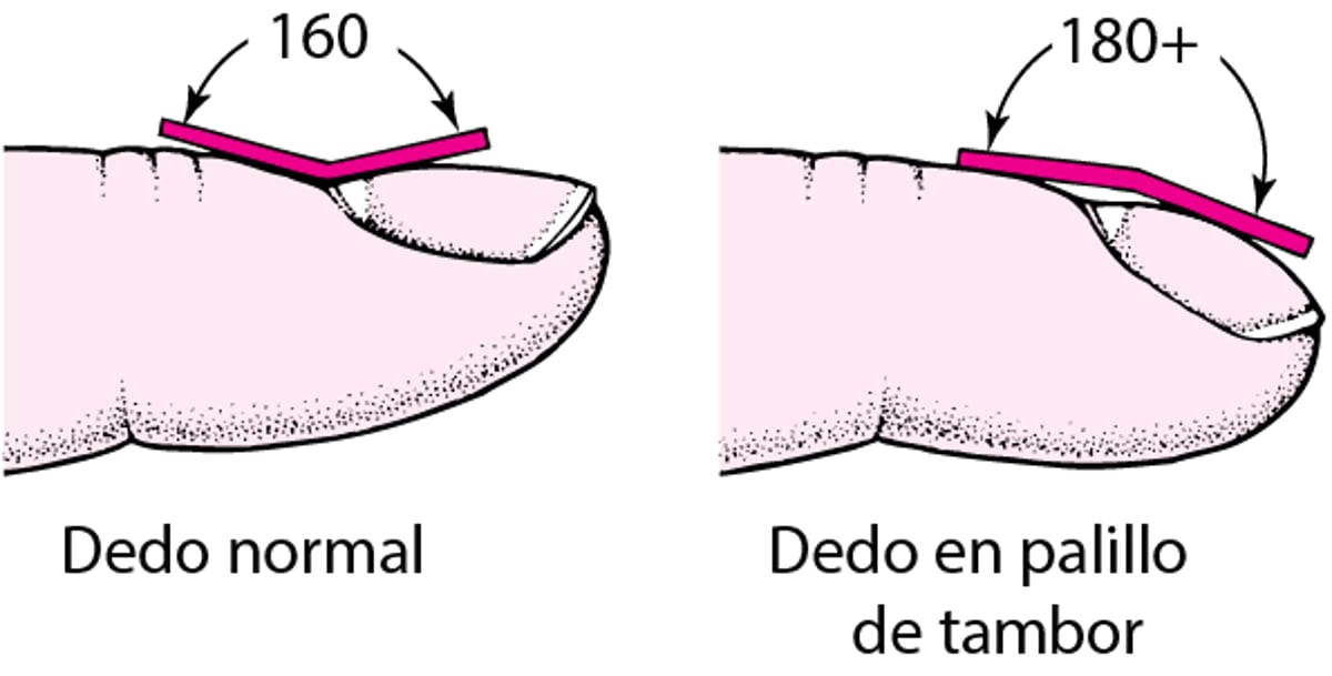 Dedos en palillo de tambor