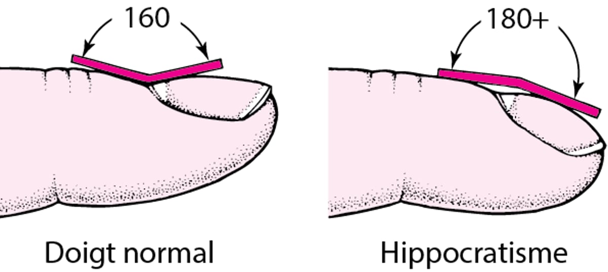 Comment reconnaître l’hippocratisme digital