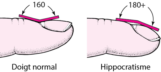 Doigt En Rond Image:Comment reconnaître l’hippocratisme digital-Manuels MSD pour le ...