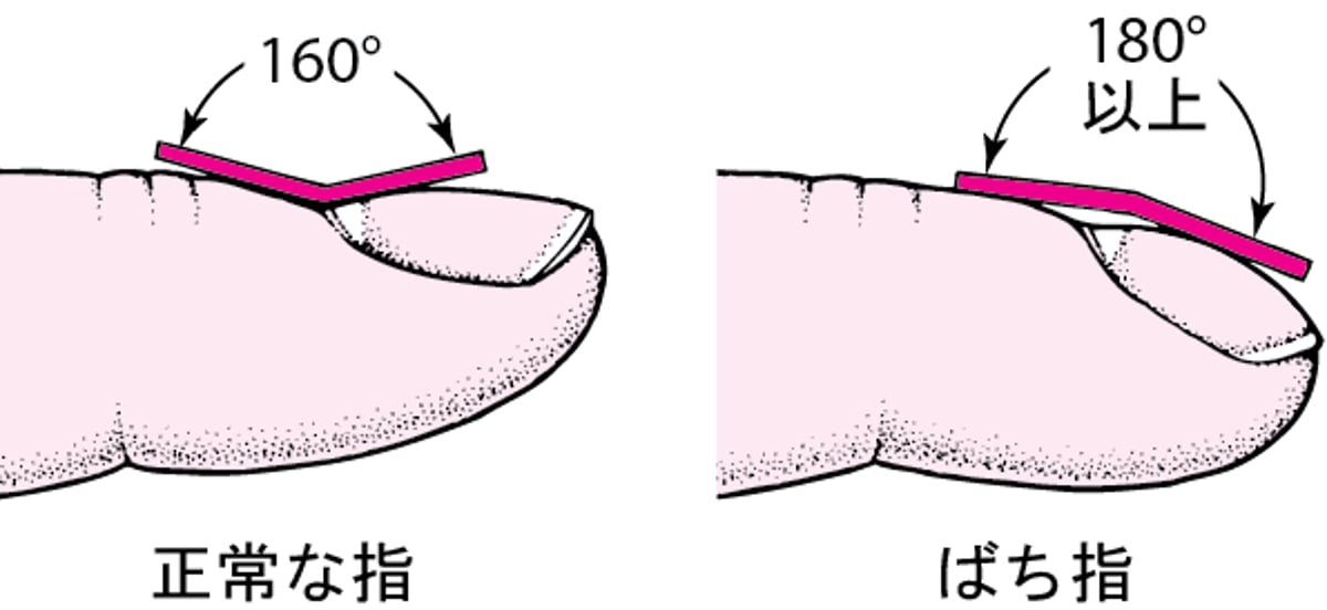 ばち指を見分ける