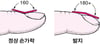 손가락 곤봉증 인식