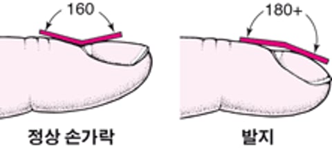 손가락 곤봉증 인식