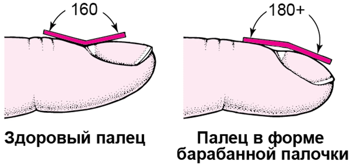 Распознавание утолщения концевых фаланг пальцев