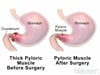 Pyloric Stenosis
