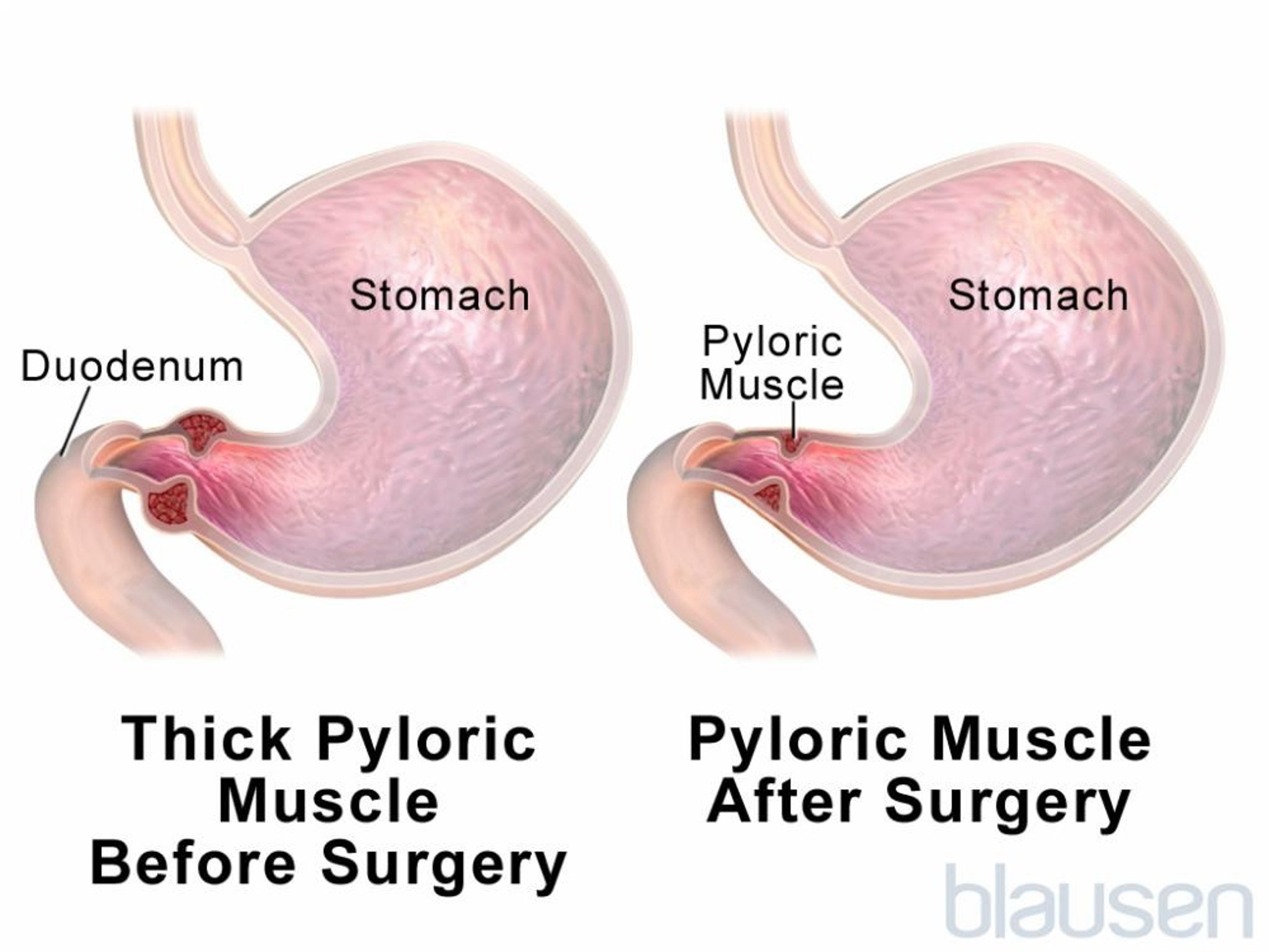 Pyloric Stenosis