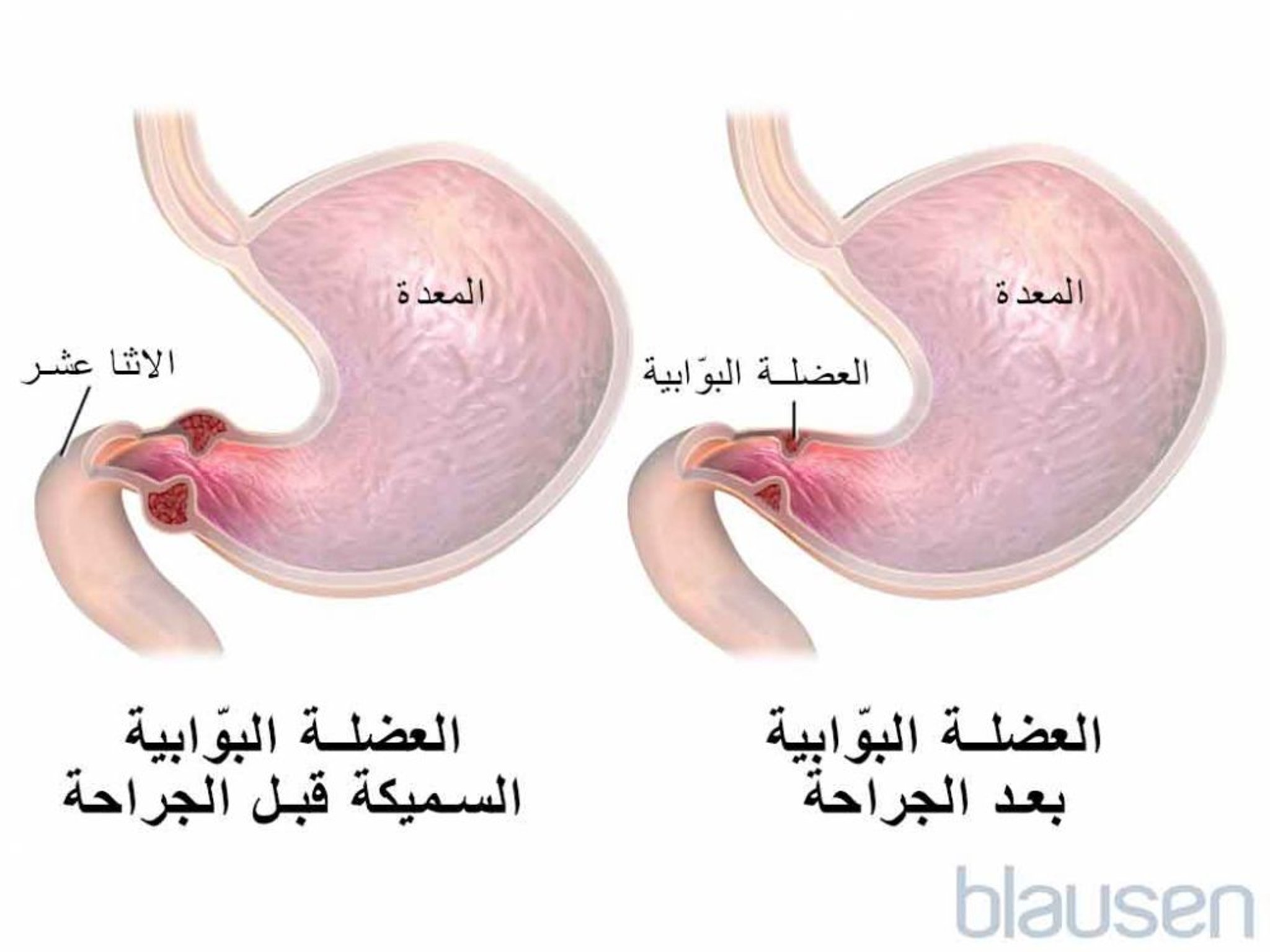 تضيّق البواب