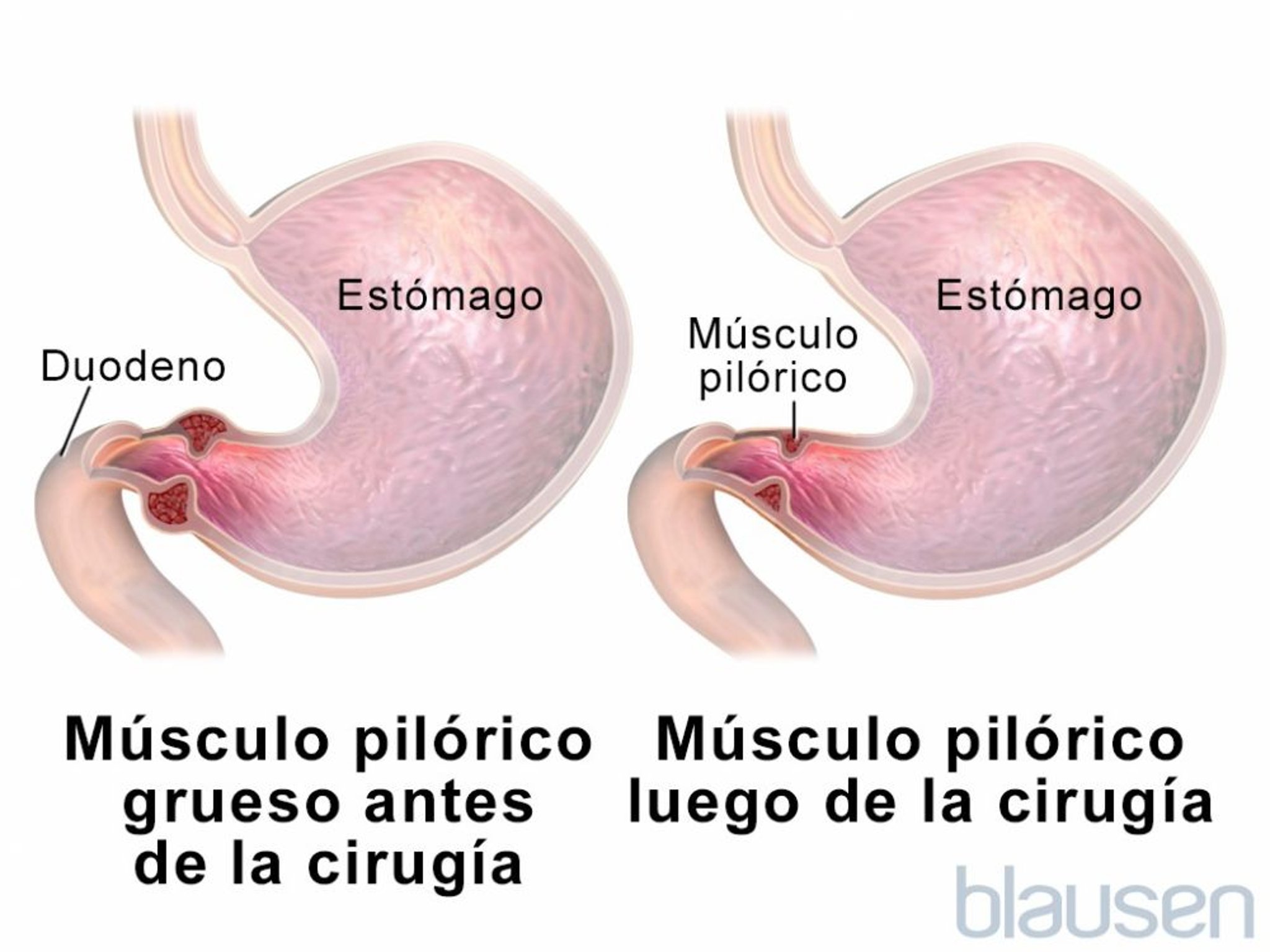 Estenosis pilórica