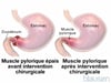 Sténose du pylore