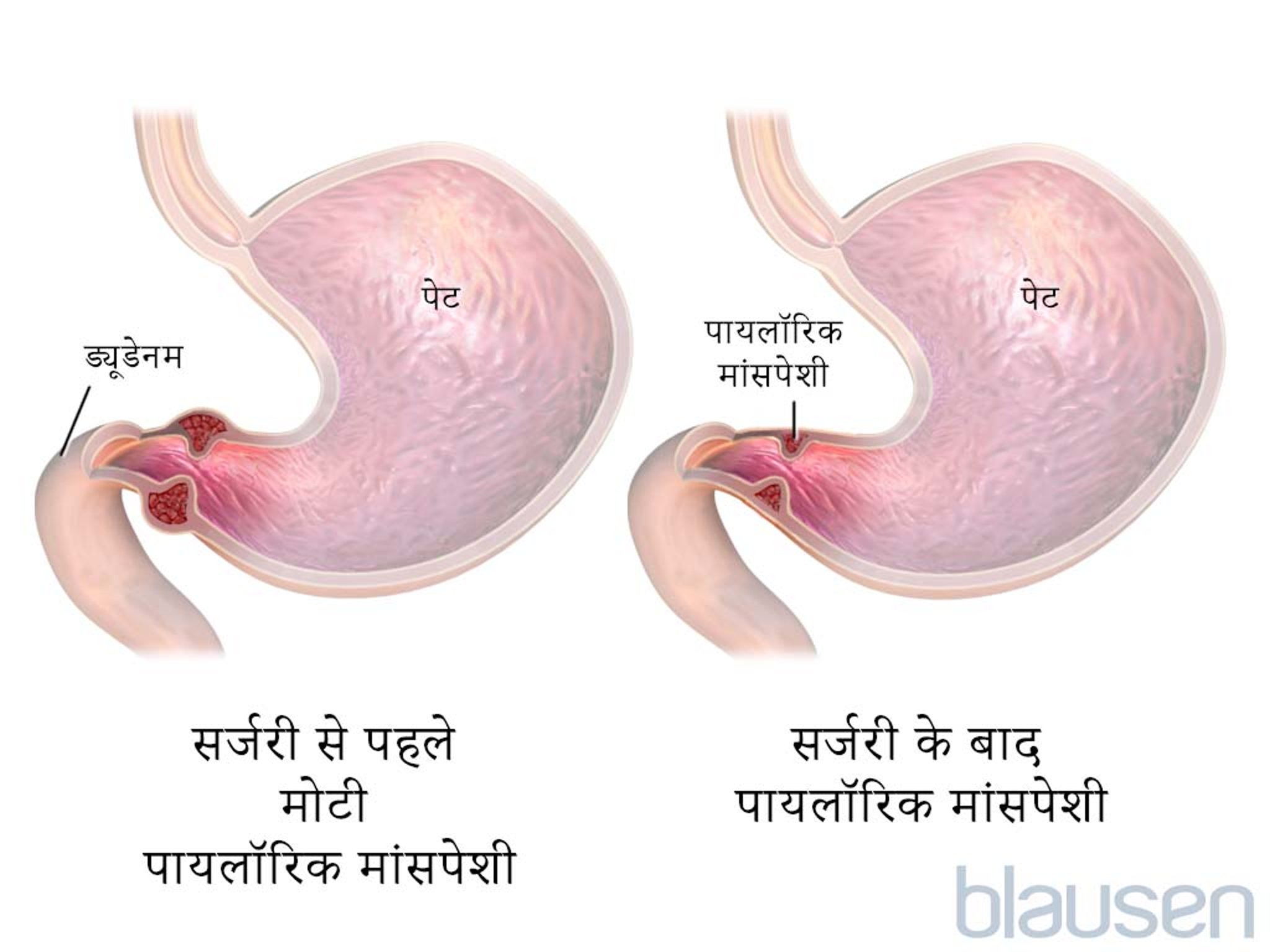 पाइलोरिक स्टेनोसिस