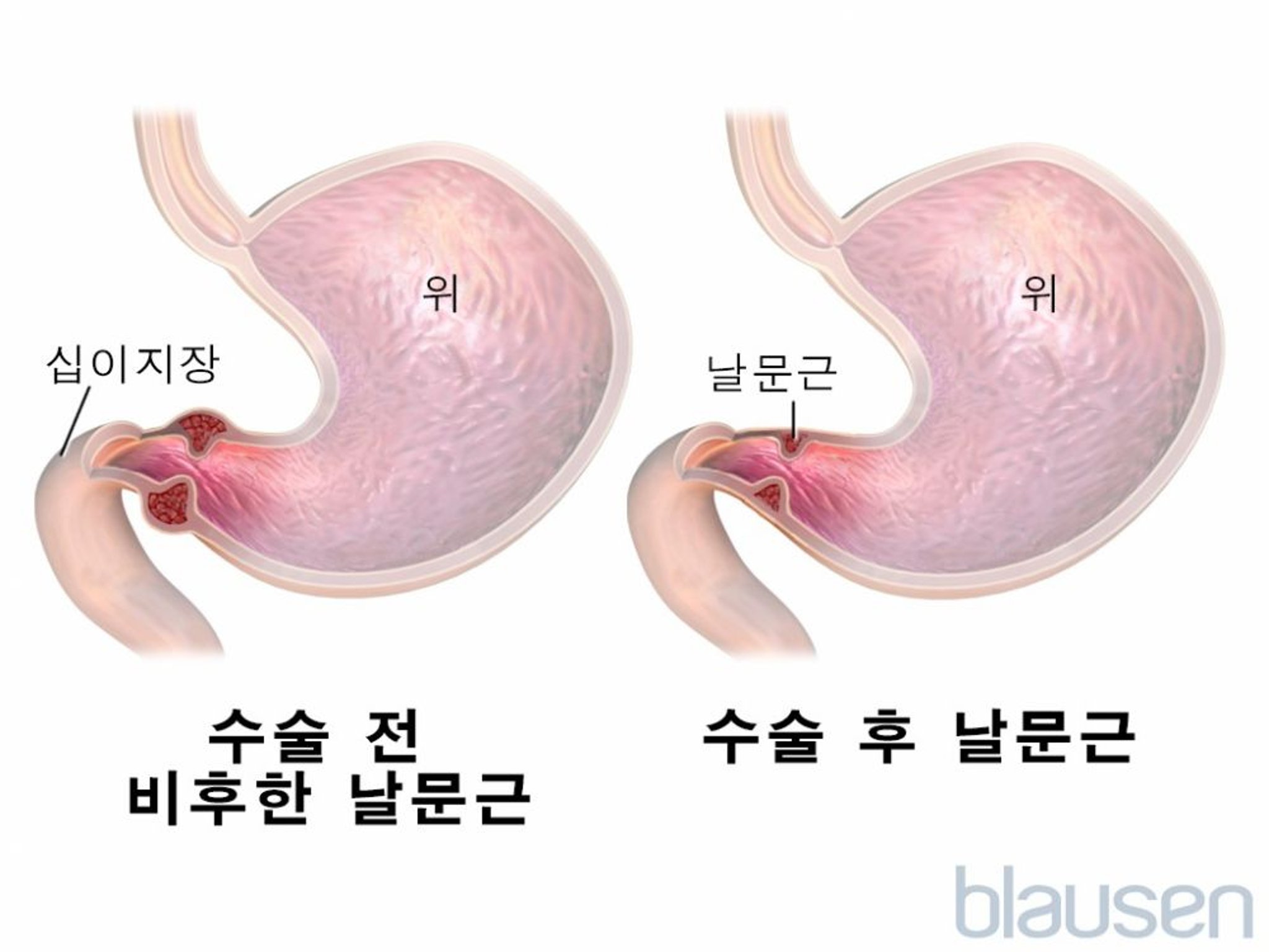 유문 협착
