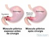 Estenose pilórica