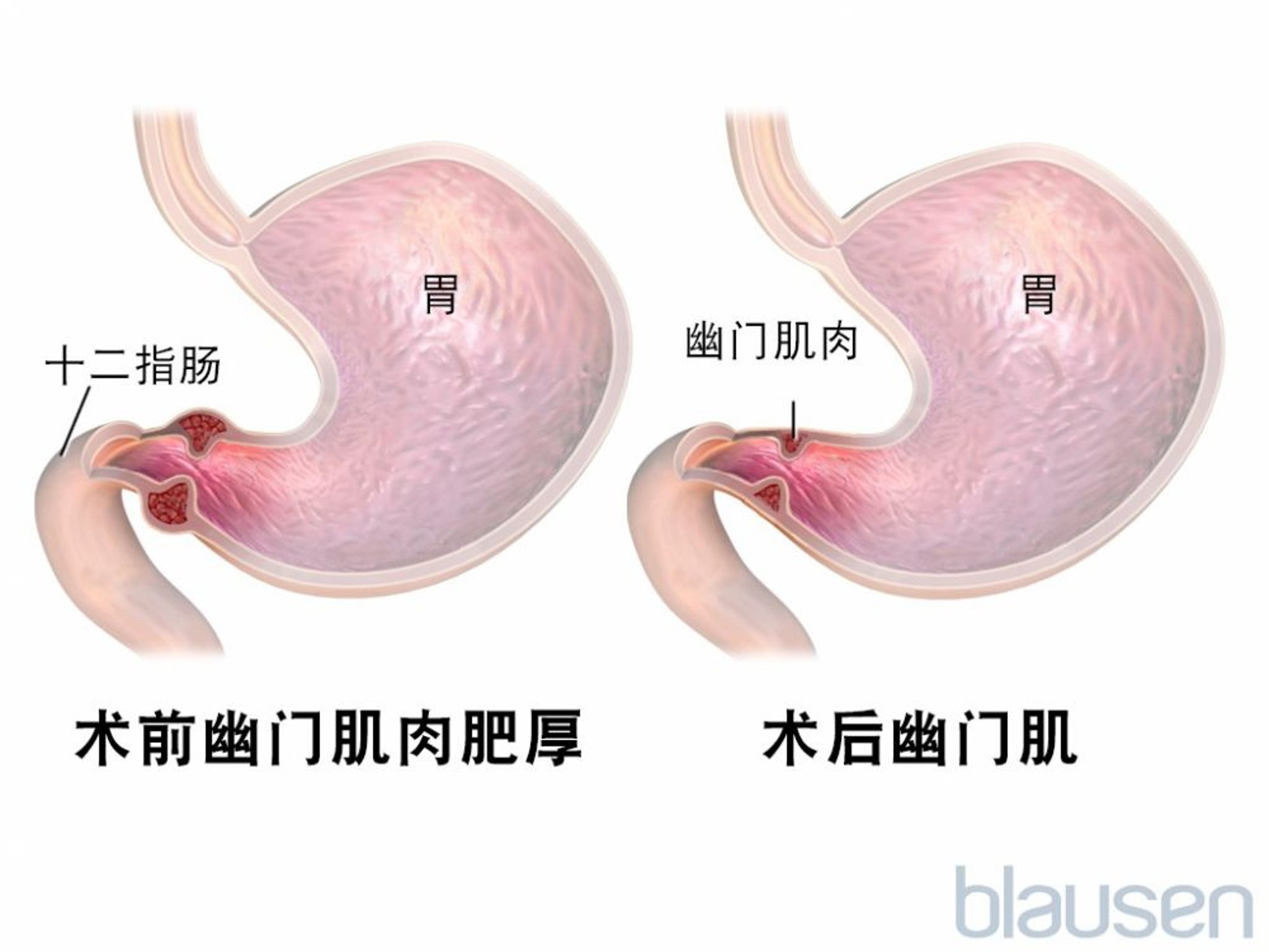 幽门狭窄