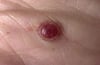 Granuloma pyogenicum