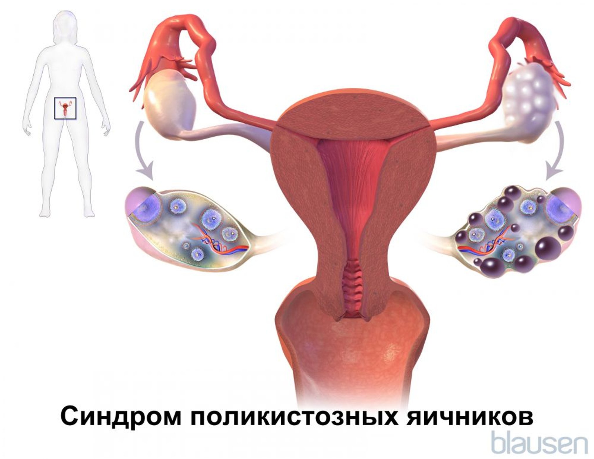 Синдром поликистозных яичников (СПКЯ)