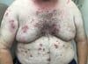 Pemphigus Vulgaris (Mmomonyoko)