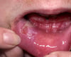 Pemphigus Vulgaris (Vidonda vya Mdomoni),