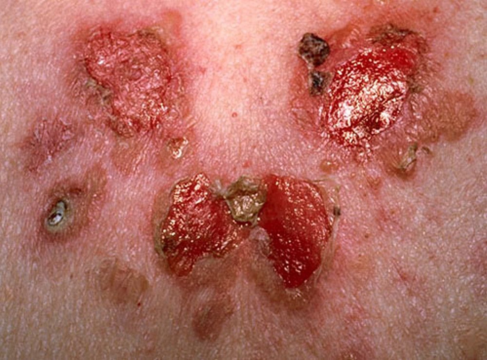 Pemphigus Vulgaris (Kubdanuka na Vidonda Wazi),