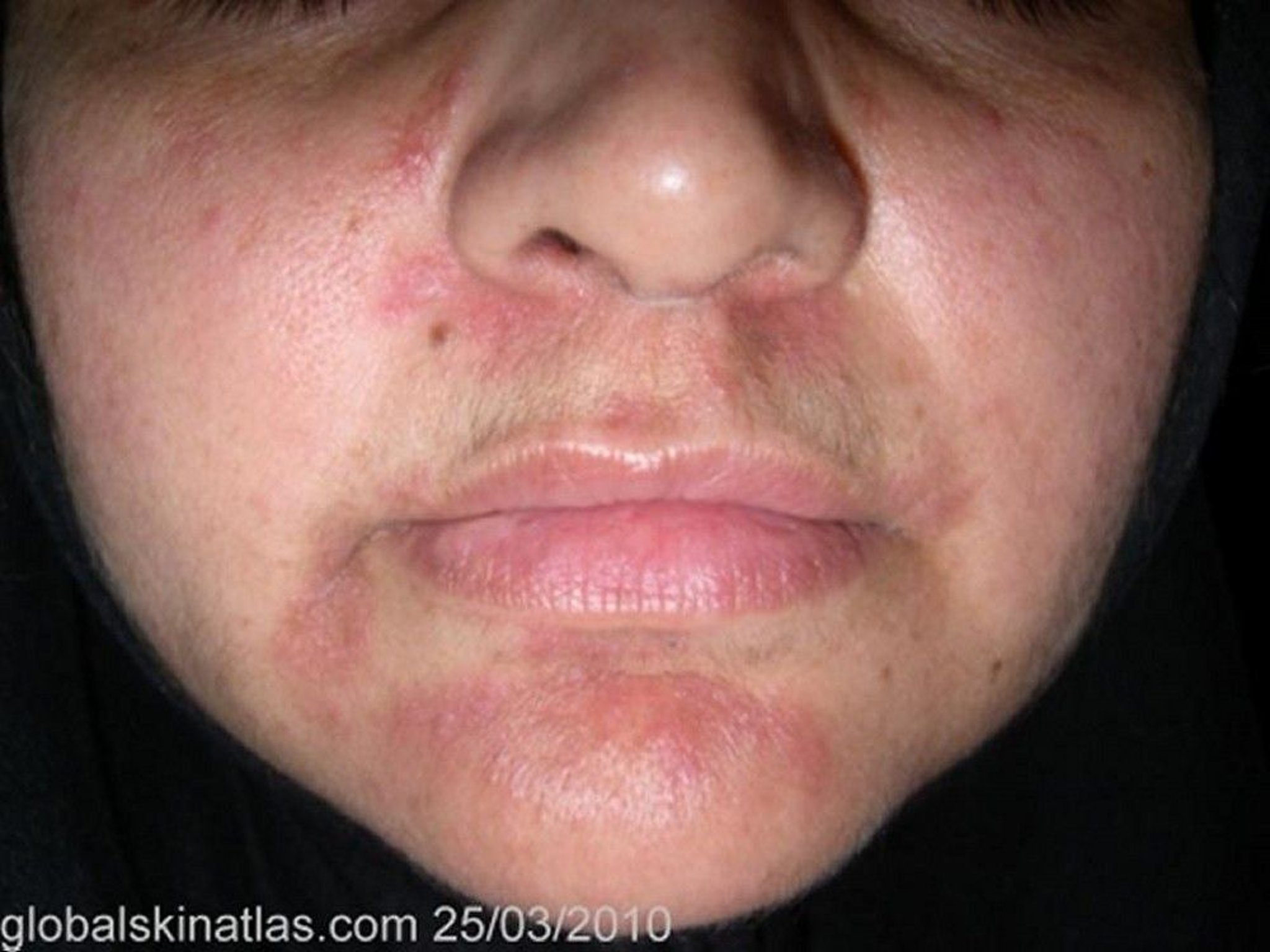 Perioral Dermatitis